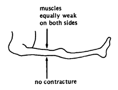 Without muscle imbalance - Contractures less likely.