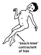 A child with 'knock-knee' contracture of hips