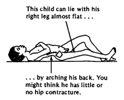 This child can lie with his right leg almost flat ...... by arching his back. You might think he has little or no hip contracture. 