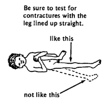  Be sure to test for contractures with the leg lined up straight.