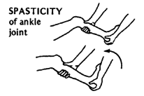  SPASTICITY of ankle joint 