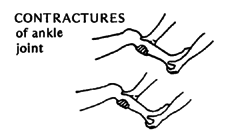  CONTRACTURES of ankle joint