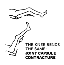THE KNEE BENDS THE SAME: JOINT CAPSULE CONTRACTURE