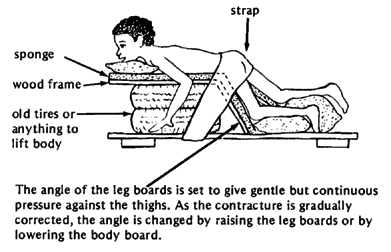 The angle of the leg boards is set to give gentle but continuous pressure against the thighs. As the contracture is gradually corrected, the angle is changed by raising the leg boards or by lowering the body board.