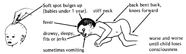 The signs of meningitis