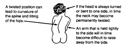 A twisted position can lead to curvature of the spine and tilting of the hips. If the head is always turned or bent to one side, in time the neck may become permanently twisted. An arm that is held tightly to the side will in time become difficult to raise away from the side.
