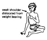 Wweak shoulder dislocated from weight bearing.