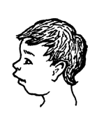A child with severe arthritis in the neck.