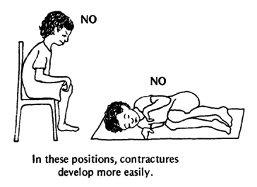 NO: In these positions, contractures develop more easily.