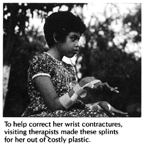 To help correct her wrist contractures, visiting therapists made these splints for her out of costly plastic.
