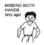 Missing both hands (any age)