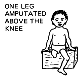 One leg amputated above the knee.