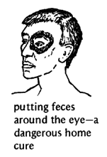 Putting feces-around the eye - a dangerous home cure.