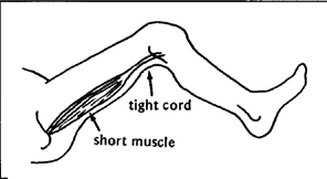 The muscle and cord are too short and tight.
