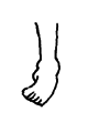 A child's foot bends in more but does not bend out.