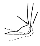 Ankle movement can be done by cutting back the sides of the brace here.