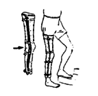 The simplest kind of above-knee plastic brace.