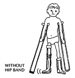A child whose leg is so weak at the hip.